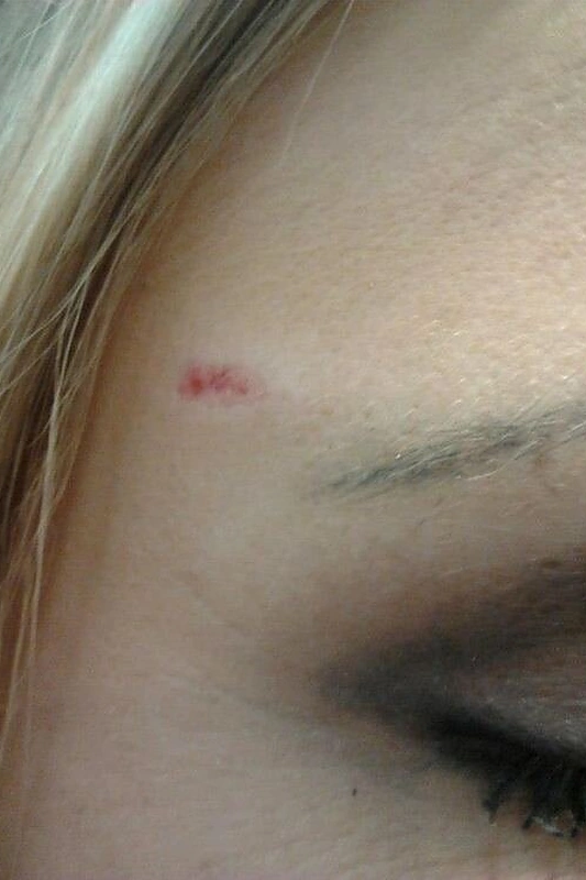 Sumuštas Oksanos Skleriūtės antakis