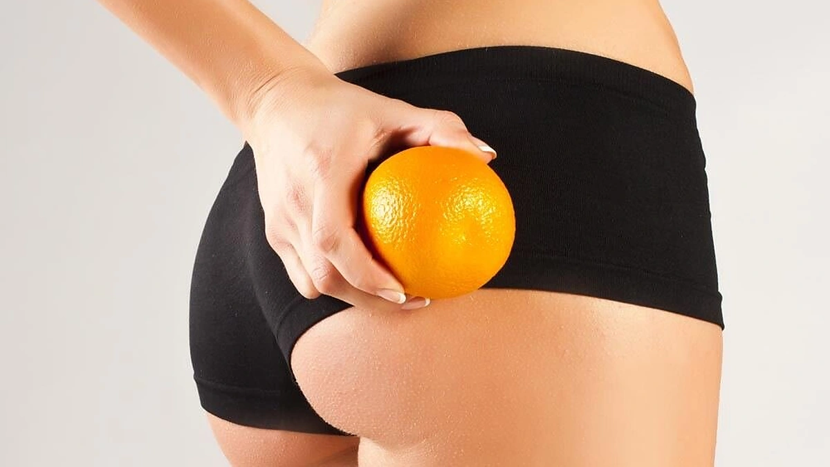 Celiulitas. Ar yra šansų jo atsikratyti?