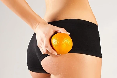 5 mitai apie celiulitą