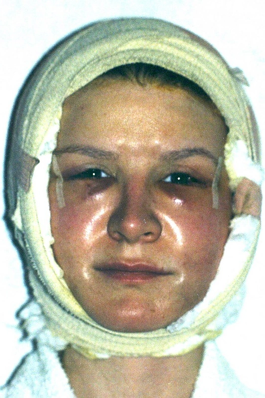 42-ejų Cindy Jackson po operacijos