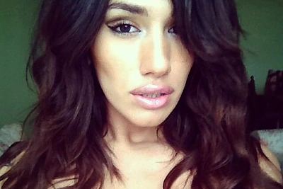 Agness Landau hialurono rūgšties injekcijomis paputlino lūpas