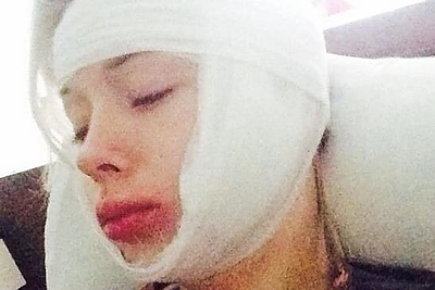 Sutvarstytą veidą parodžiusi barbė Valerija Lukjanova sako buvusi užpulta: „Toks mano Helovinas“