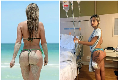 Grožio auka: brazilė Andressa Urach dėl užpakaliuko implantų vos neprarado gyvybės
