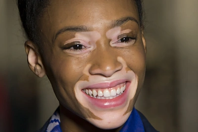 10 išskirtinės išvaizdos modelių: ligos, amžius ar trūkumai tapo jų privalumais