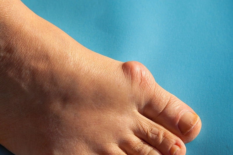 Iššokęs pėdos kauliukas