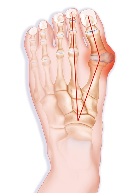 Iššokęs pėdos kauliukas