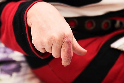 Romos Mačiulytės sužalota ranka