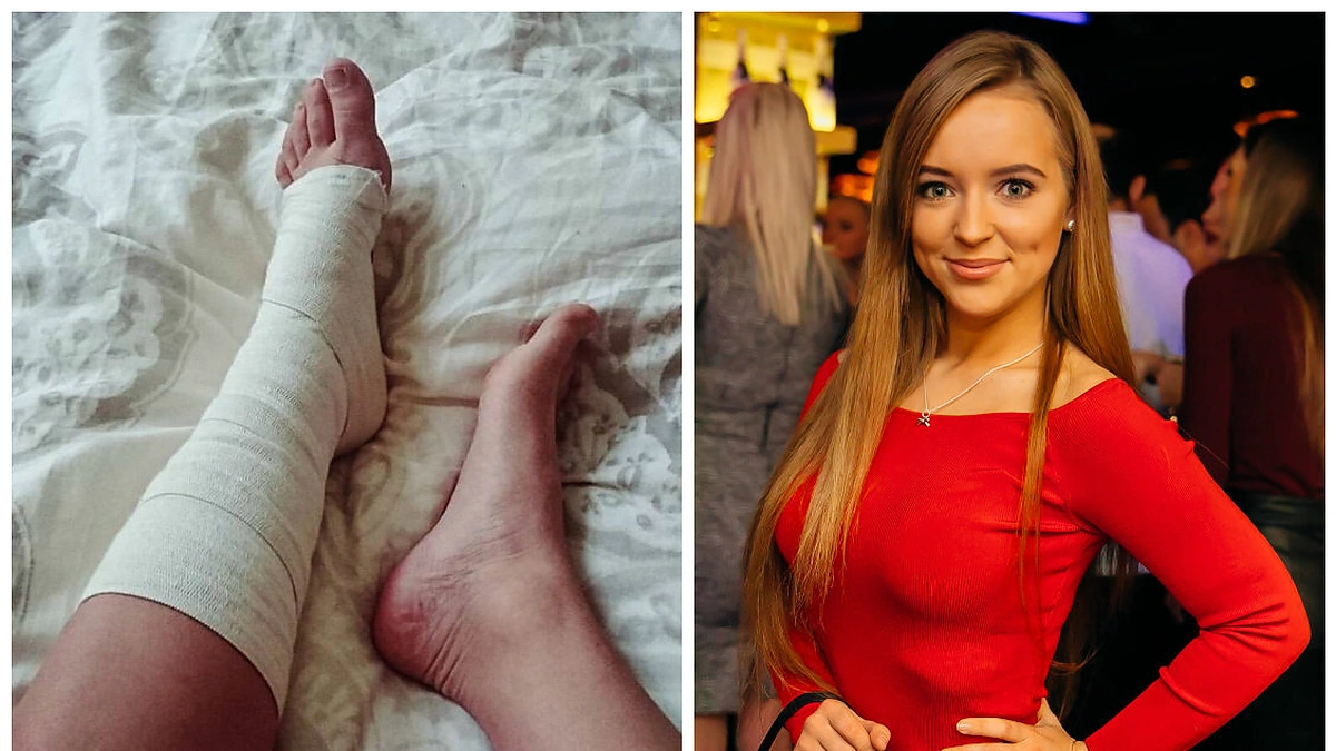 Monika Šalčiūtė ir jos patempta koja