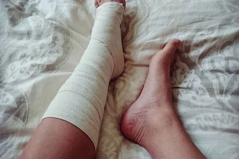 Monikos Šalčiūtės koja