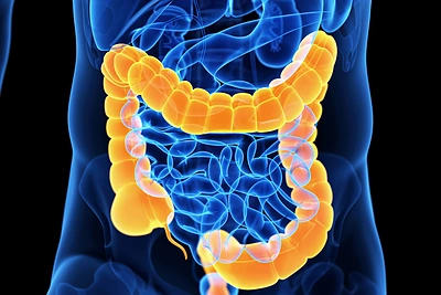 Storosios žarnos vėžys – trečia pagal dažnumą onkologinė liga