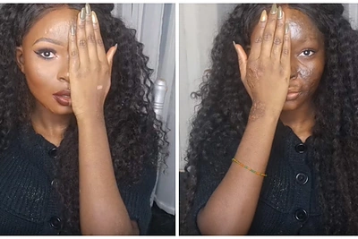 Veidą nudegusi mergina pademonstravo makiažo galią: „Myliu abi savo puses“