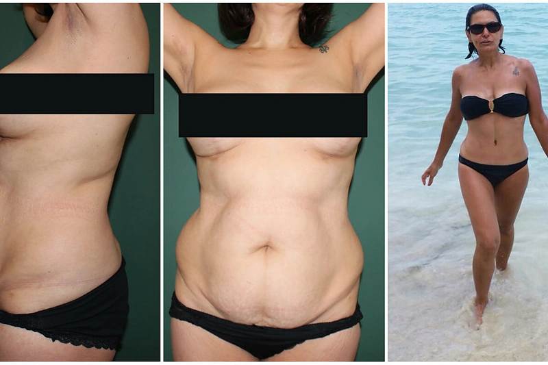 Maja (46 m.) prieš operaciją ir po operacijos