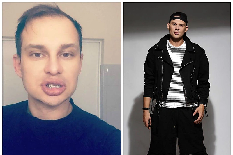 Į avariją patekusiam Soliariui lūžo žandikaulis: „Dabar teks pabūti su geležiniais dantimis“