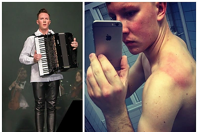 Martynas Levickis parodė, kokius įspaudus po koncerto paliko akordeono diržai