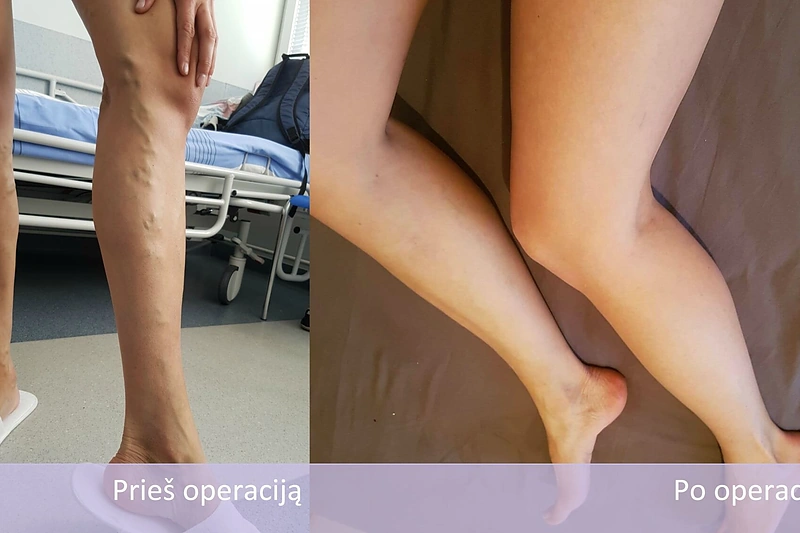 Vlados Musvydaitės kojos prieš venų operaciją ir po jos