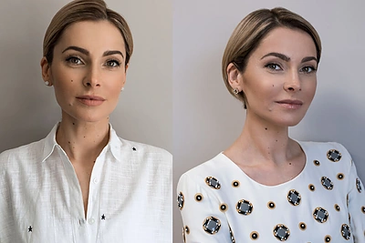 Agnė Jagelavičiūtė ryžosi procedūrai lazeriu