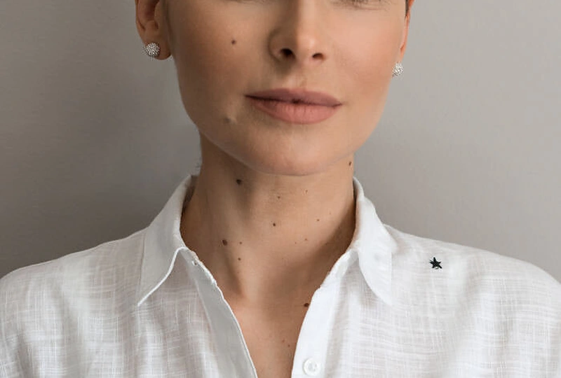 Agnė Jagelavičiūtės išbandė apgamų šalinimo lazeriu procedūrą