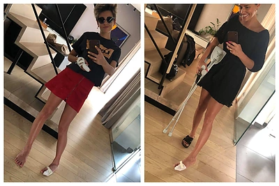 Nesėkminga Vidmantės Martikonytės vasara: įtvare ir kojos, ir rankos pirštai