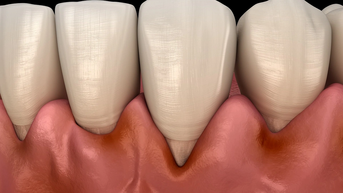 Parodontozė / 123rf.com nuotr.