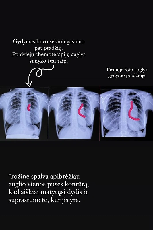 Indrė Burlinskaitė-Vaisieta parodė, kaip nyko auglys jos krūtinėje / Socialinių tinklų nuotr.