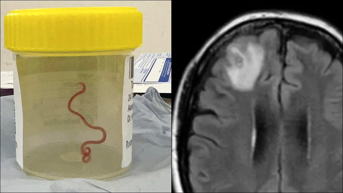 Smegenyse pastebėta gyva kirmelė / AFP/„Scanpix“ nuotr.