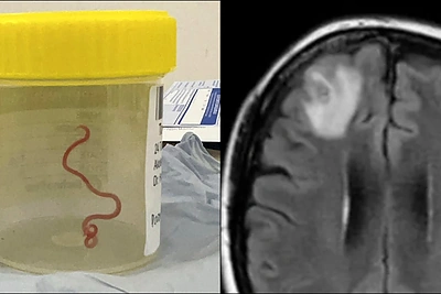 Pirmas toks atvejis pasaulyje: žmogaus smegenyse rasta gyva kirmėlė