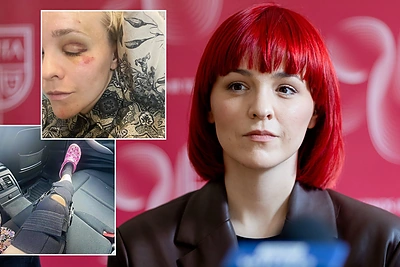 Stipriai susižalojusi atlikėja Bjelle: „Dabar jau galiu drąsiai teigti – esu buvusi paspirtukininkė“