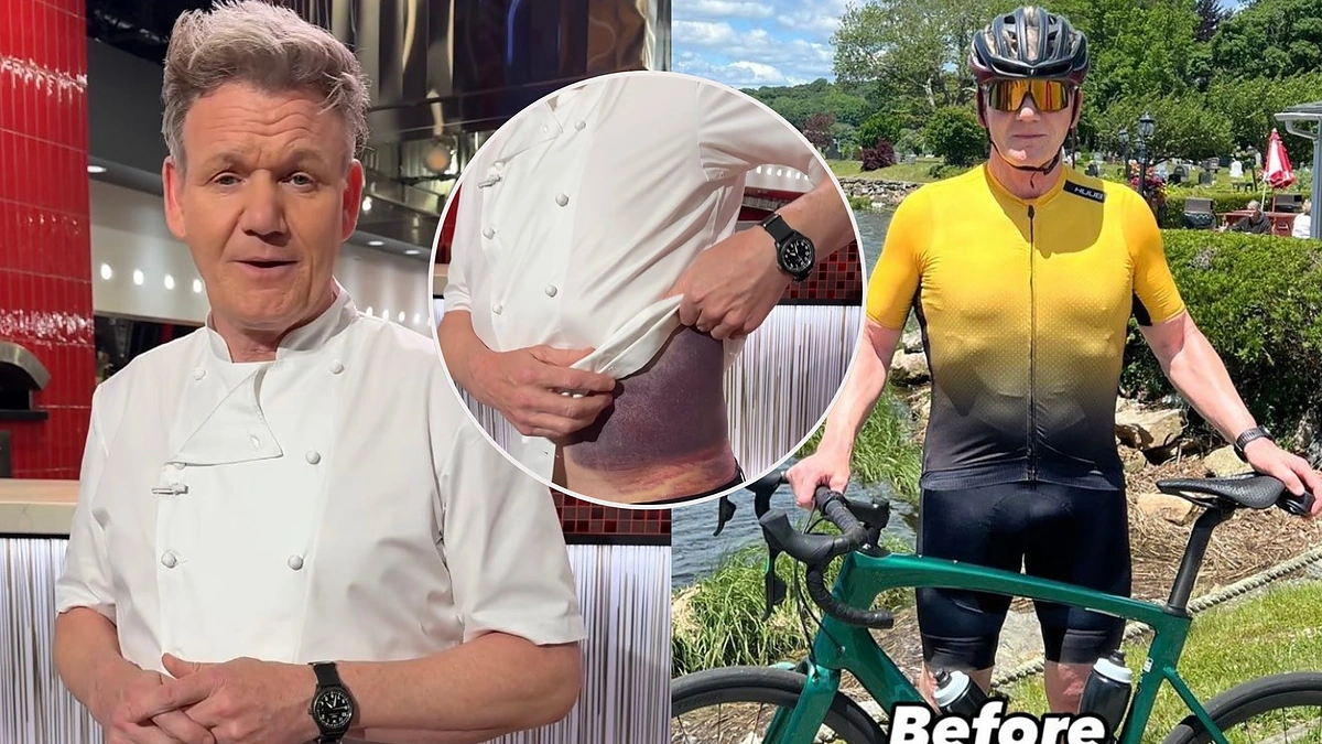 Gordonas Ramsay po dviračio avarijos / Socialinių tinklų nuotr.