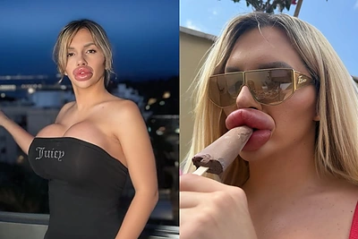 Moteris nebegali sučiaupti lūpų, bet sustoti – neketina: „Esu apsėsta“