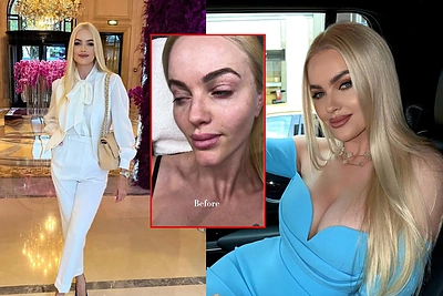 Neringa Šiaudikytė išbandė Kim Kardashian pamėgtą grožio procedūrą: kaina šokiravo