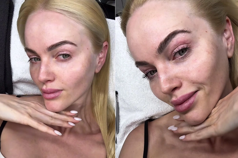 Neringa Šiaudikytė prieš ir po procedūros / Socialinių tinklų nuotr.