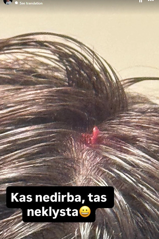 Aurimas Valujavičius patyrė traumč / „Instagram“ nuotr.