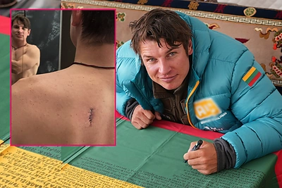 Aurimui Valujavičiui atlikta ilgai atidėliota operacija – nugaroje 4 cm žaizda: „Nesekit mano pavyzdžiu“