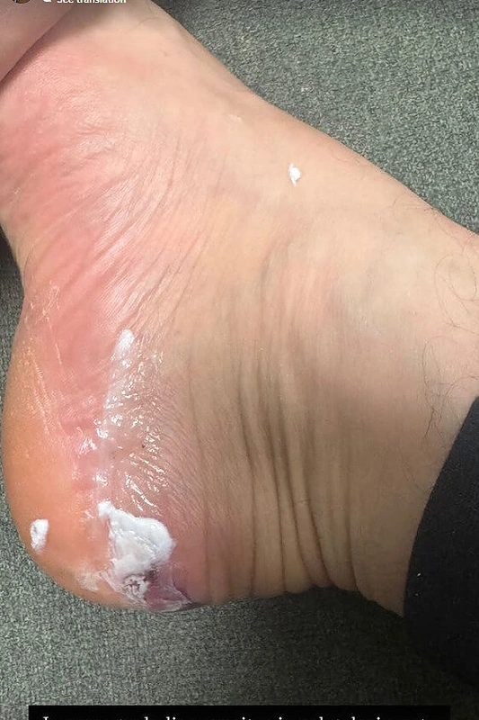 Simas Kučas patyrė traumą / „Instagram“ nuotr.