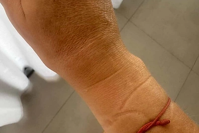Ieva Voveris patyrė riešo traumą / Asmeninio archyvo nuotr.