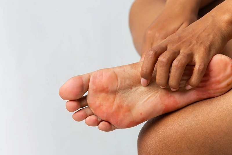 Pėdų grybelis / Shutterstock nuotr.