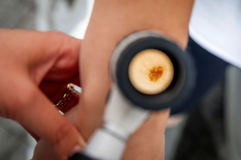 Euromelanomos diena: nemokami profesionalūs tyrimai ir išgelbėtos gyvybės / „Sapiegos klinikos“ nuotr.